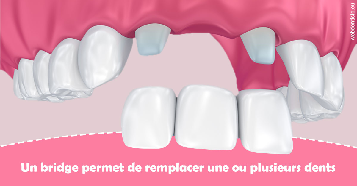 https://dr-gruson-xavier.chirurgiens-dentistes.fr/Bridge remplacer dents 2