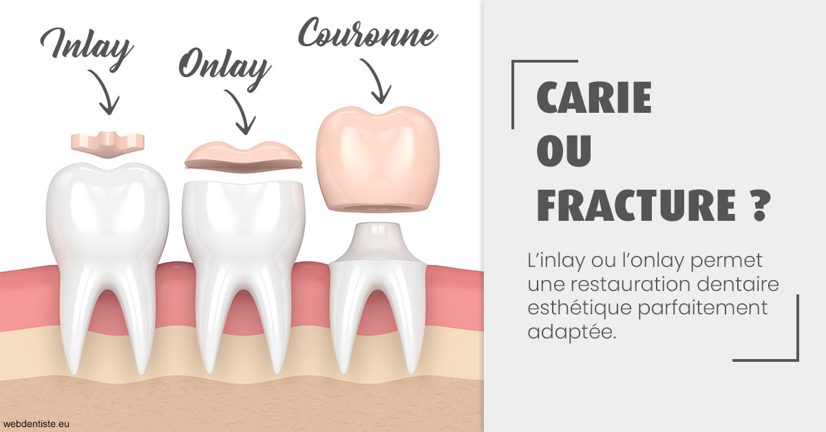 https://dr-gruson-xavier.chirurgiens-dentistes.fr/T2 2023 - Carie ou fracture 1