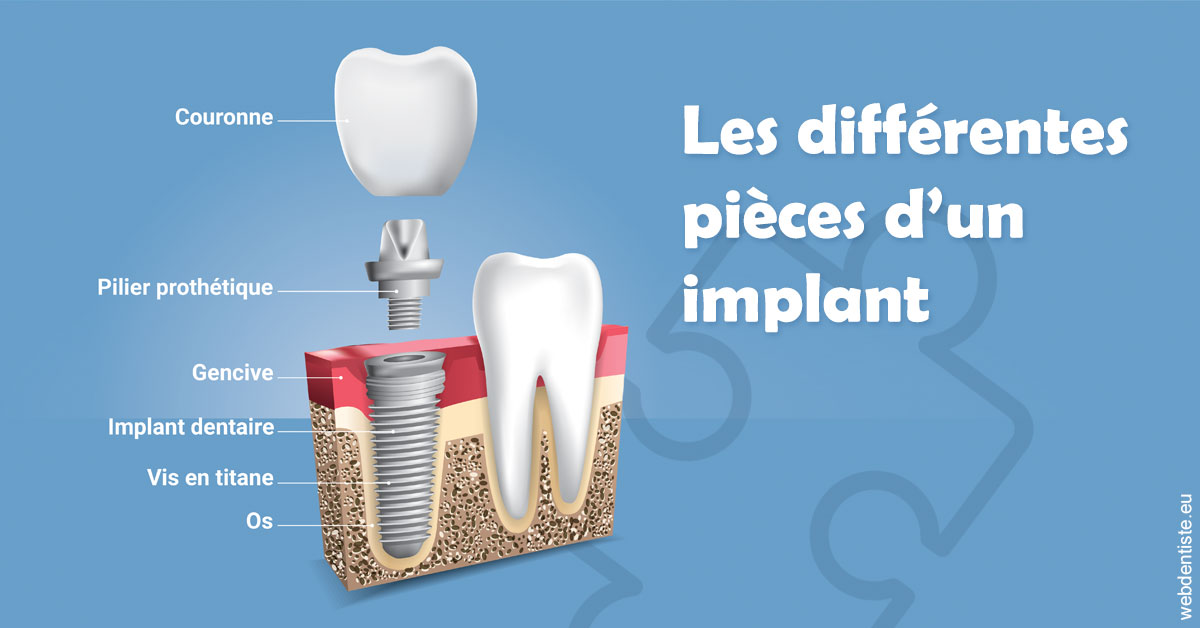 https://dr-gruson-xavier.chirurgiens-dentistes.fr/Les différentes pièces d’un implant 1
