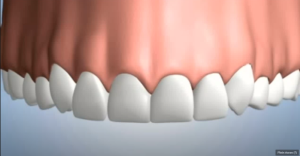 Les conséquences de l'absence d'une dent