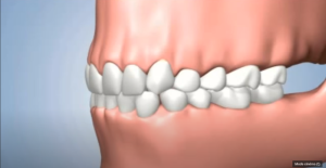 Conséquences de l'absence de toutes les dents